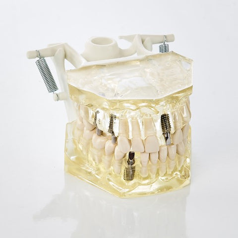 BLK 3414-TRANSPARENT JAW MODEL WITH TEETH & IMPLANT